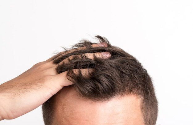 مهم ترین علت ریزش مو در مردان